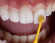 Keramik-Veneers in der Türkei: Kosten, Haltbarkeit & E-Max