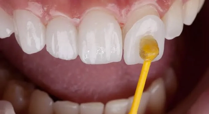 Keramik-Veneers in der Türkei: Kosten, Haltbarkeit & E-Max