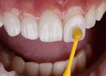 Porcelain Veneers: Turkey Costs, Smile Design & Care
