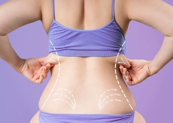 Upper Back Lift: Turkey Costs, Bra-Line Scars & Results