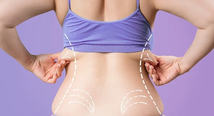 Upper Back Lift: Turkey Costs, Bra-Line Scars & Results