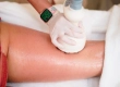 Cellulite Treatment: Laser, Subcision & Cost