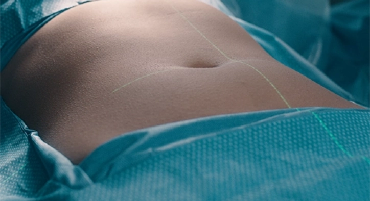 Gastric Sleeve to Bypass Revision: Results & Turkey Costs