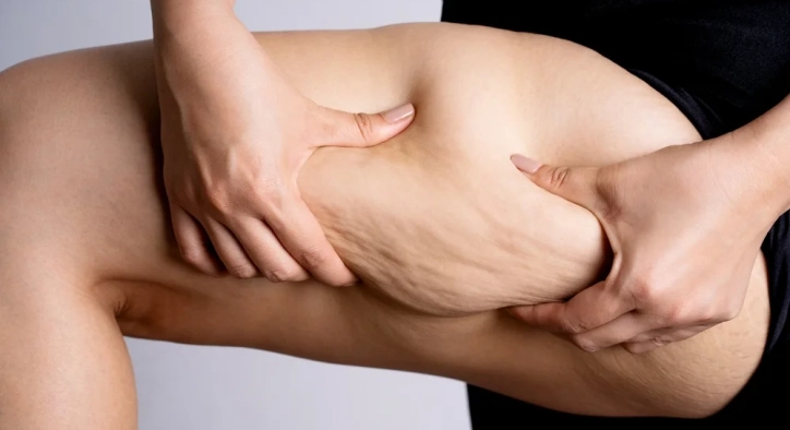 Lipedema: Symptoms, Stages & Surgery Cost